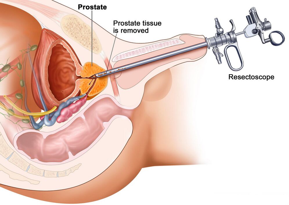 Raccolta di tessuto prostatico per una diagnosi accurata della prostatite