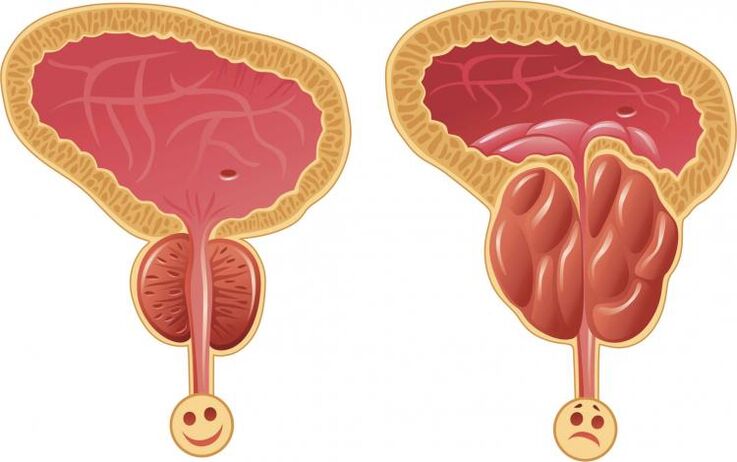 Prostata sana e prostatite