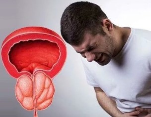I sintomi della prostatite cronica negli uomini