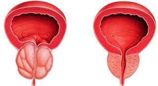 la differenza malato e sano della prostata